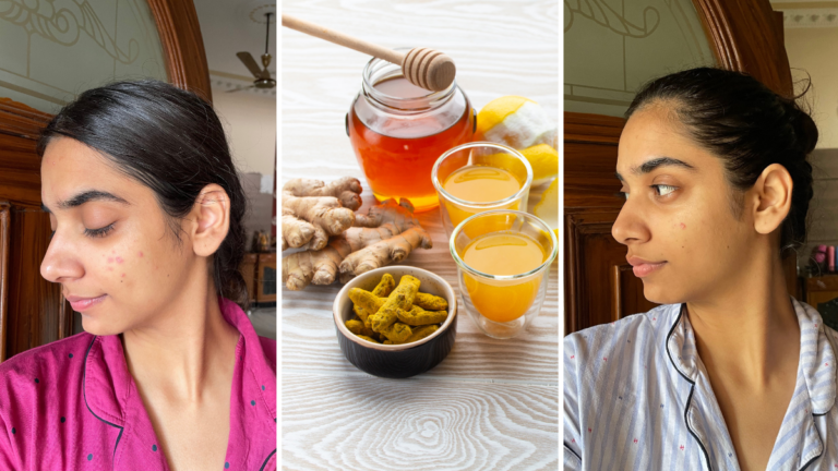 8 Home Remedies to Get Rid of Acne Scars – Because Clear Skin Is Just a Kitchen Cabinet Away!
