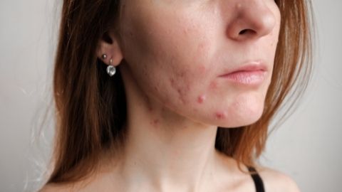 How to get rid of Acne Scars: 5 Legit home remedies that actually work! How to get rid of Acne Scars: 5 Legit home remedies that actually work!