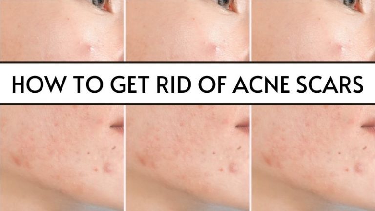 How to get rid of Acne Scars: 5 Legit home remedies that actually work!
