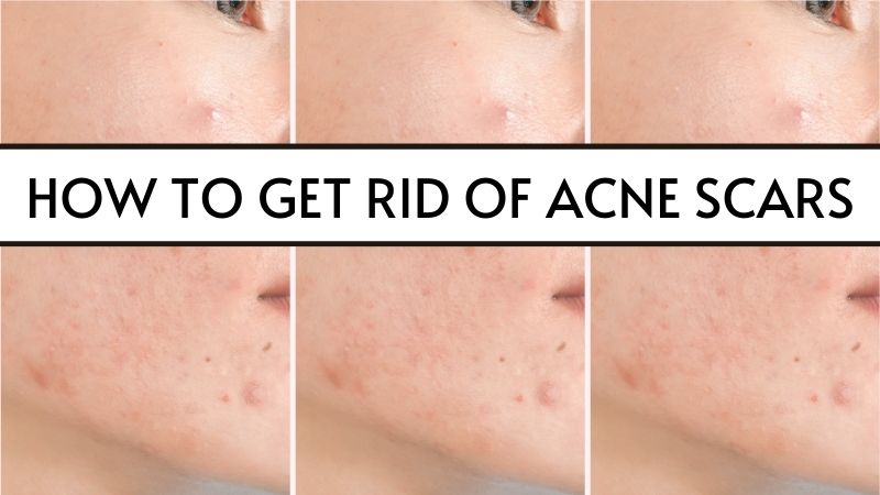 How to get rid of Acne Scars: 5 Legit home remedies that actually work! How to get rid of acne scars