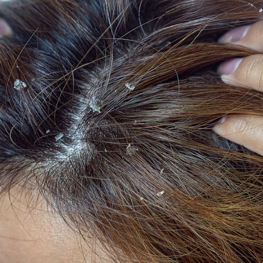 seborrheic dermatitis can be why your hair smell sp bad even after washing