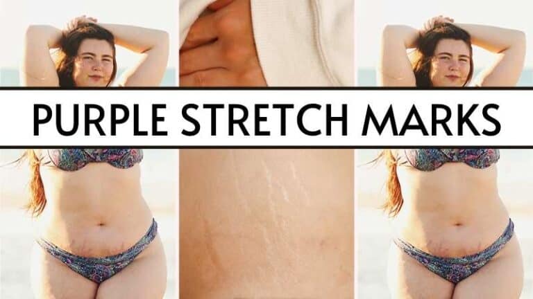 How to Get Rid of Purple Stretch Marks Naturally
