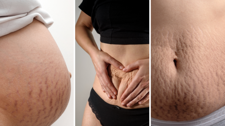 how to get rid of purple stretch marks