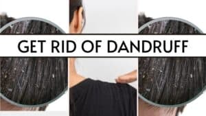 featured image how to get rid of dandruff
