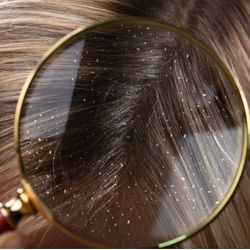 How To Get Rid Of Dandruff Naturally and Fast