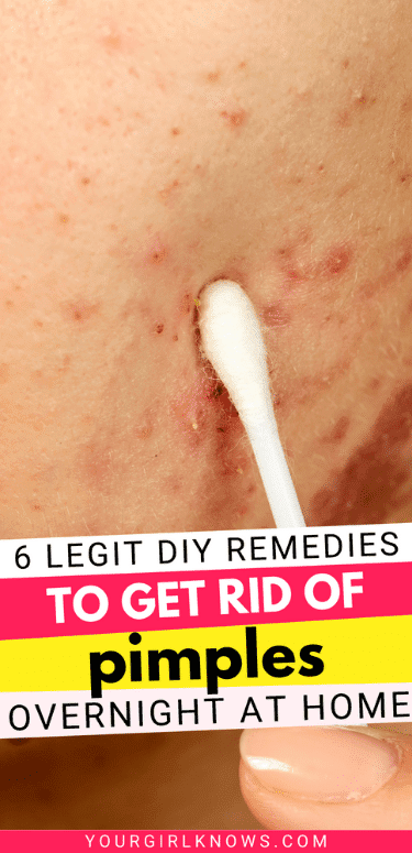 How to Get Rid of Pimples OVERNIGHT: 7 DIYs That Work!