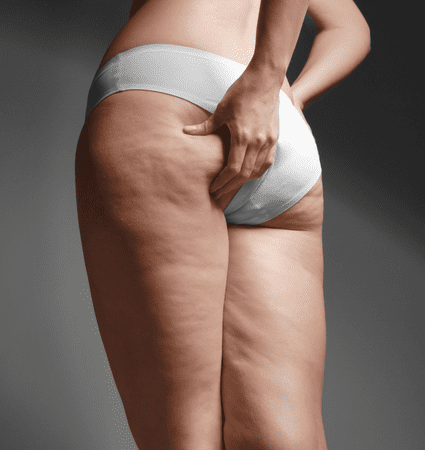 Gua Sha for Cellulite: Does it work? (Shocking answers) gua sha for cellulite buttocks
