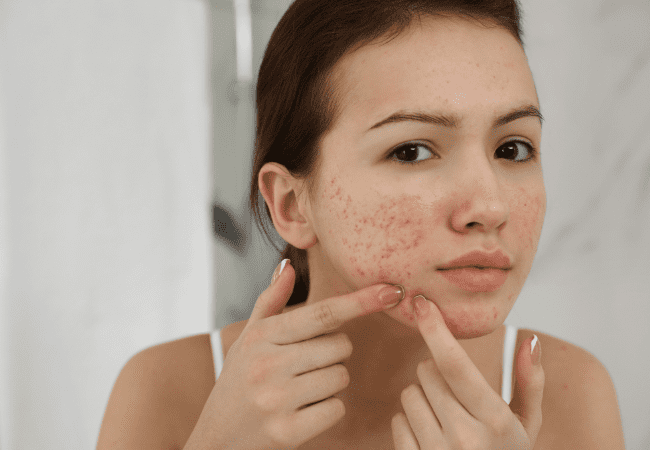 Is Cetaphil Good For Acne? Shocking truth you won't like!
