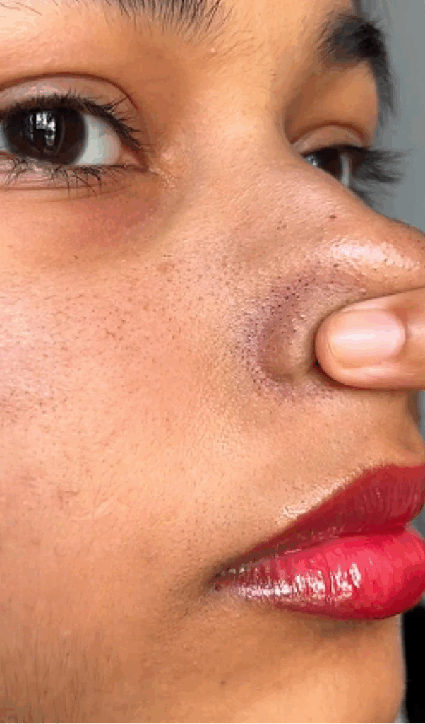 How to Get Rid of Blackheads (And 8 Things You Need to Stop Doing Immediately) How to Get Rid of Blackheads (And 8 Things You Need to Stop Doing Immediately)