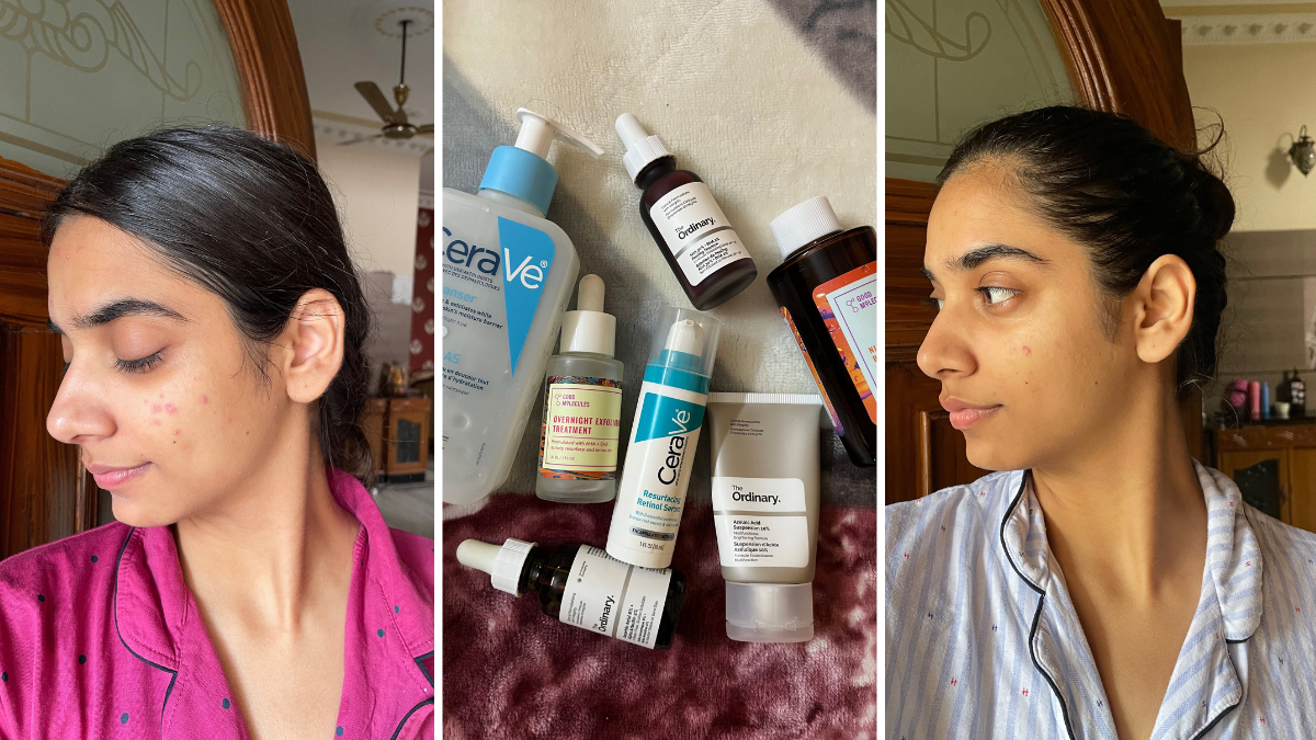 Products for Acne Scarring
