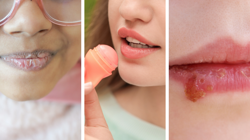 how to get rid of chapped lips