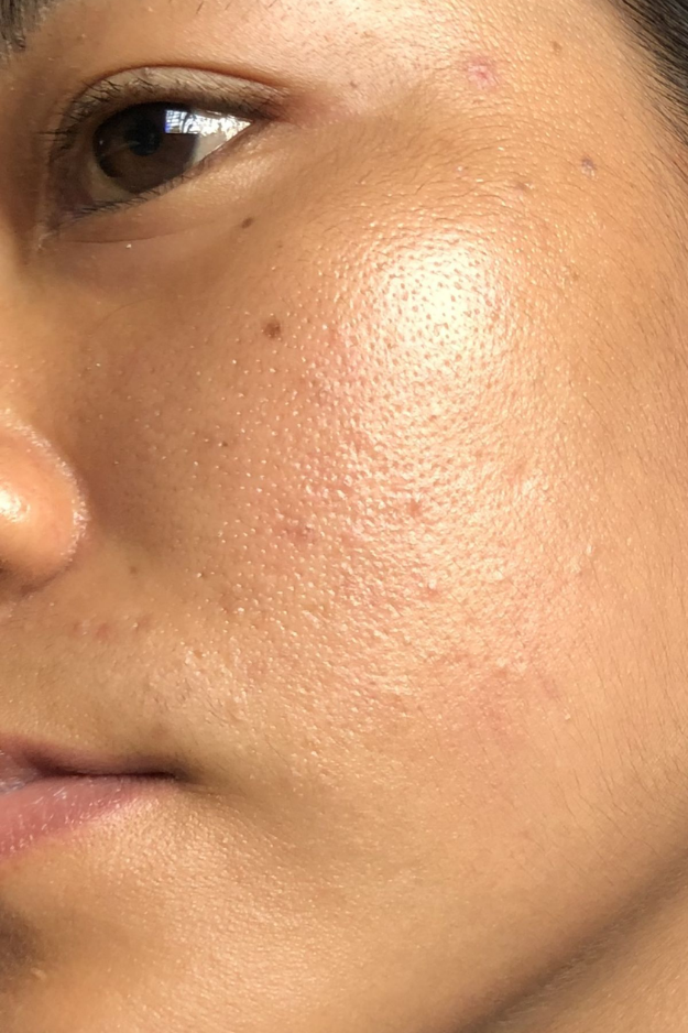 6 How to Reduce Open Pores Naturally (10 Proven Tips)